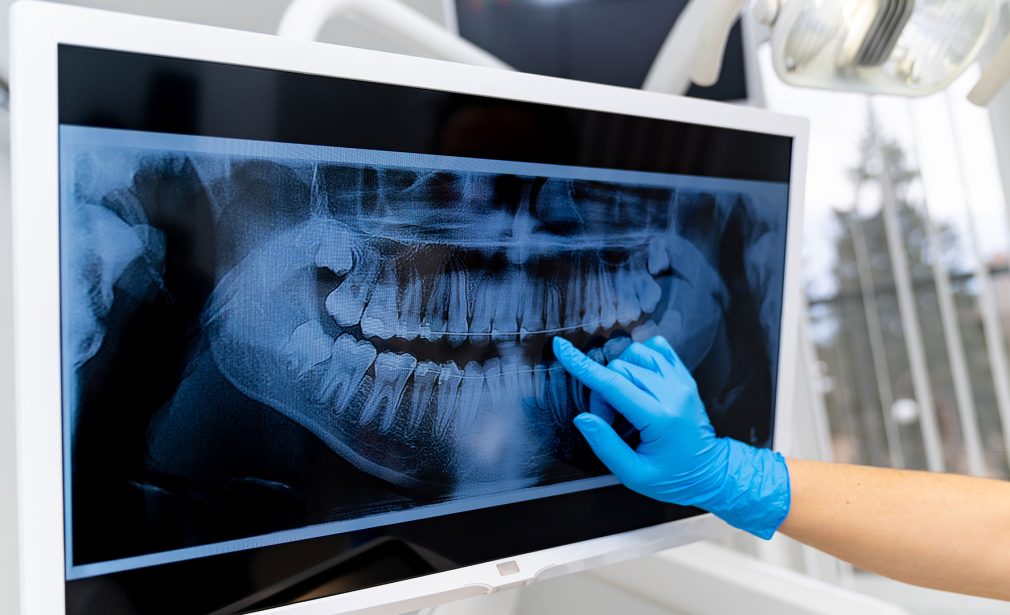 X-Rays-Dental-Radiographs-Bonita-Springs