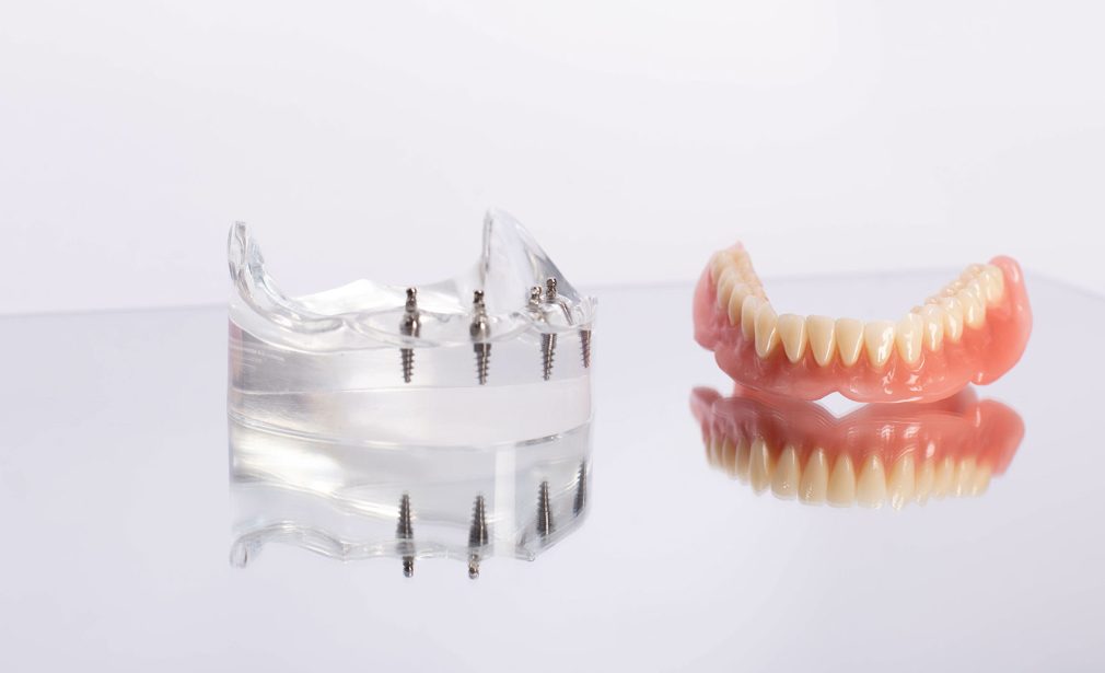 Comfortable-Overdentures-Bonita-Springs