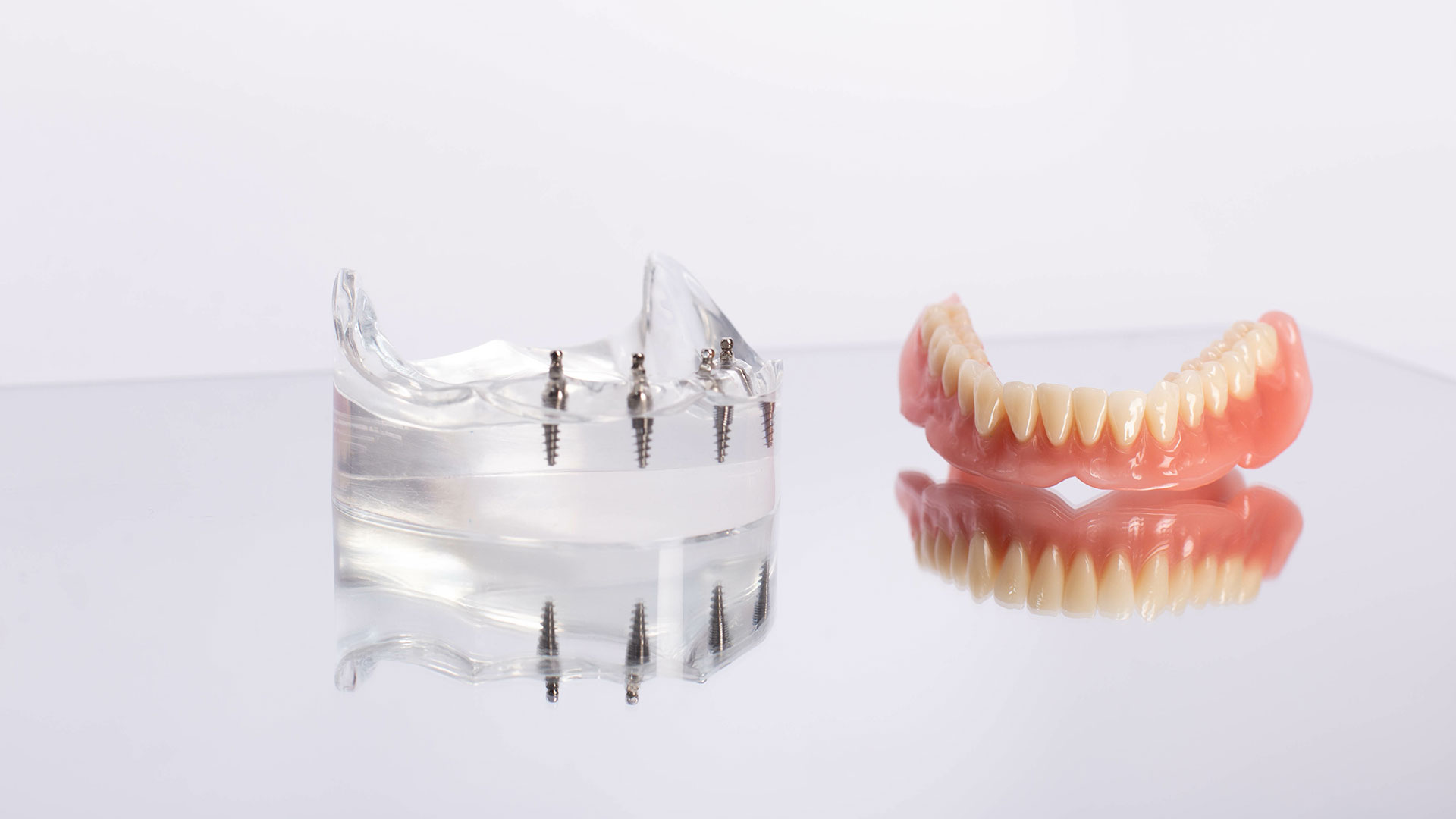 Overdentures in Bonita Springs Implant-supported overdentures and tooth replacement evaluation in Bonita Springs, FL