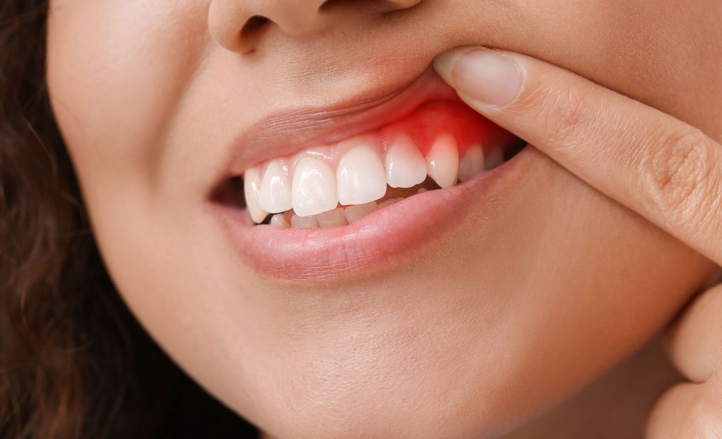 Healthy-Gums-Dental-Periodontics-Bonita-Springs