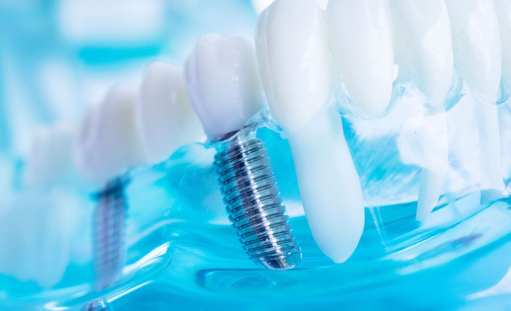 Expert dental implant dentist in Bonita Springs