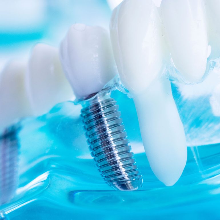 Expert dental implant dentist in Bonita Springs