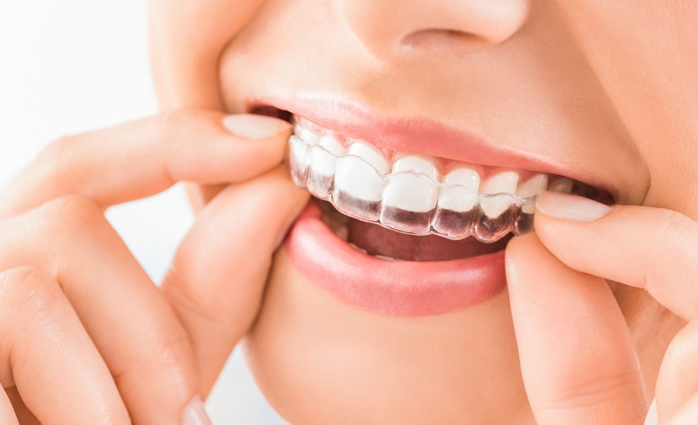 Clear aligners Invisalign in Bonita Springs FL