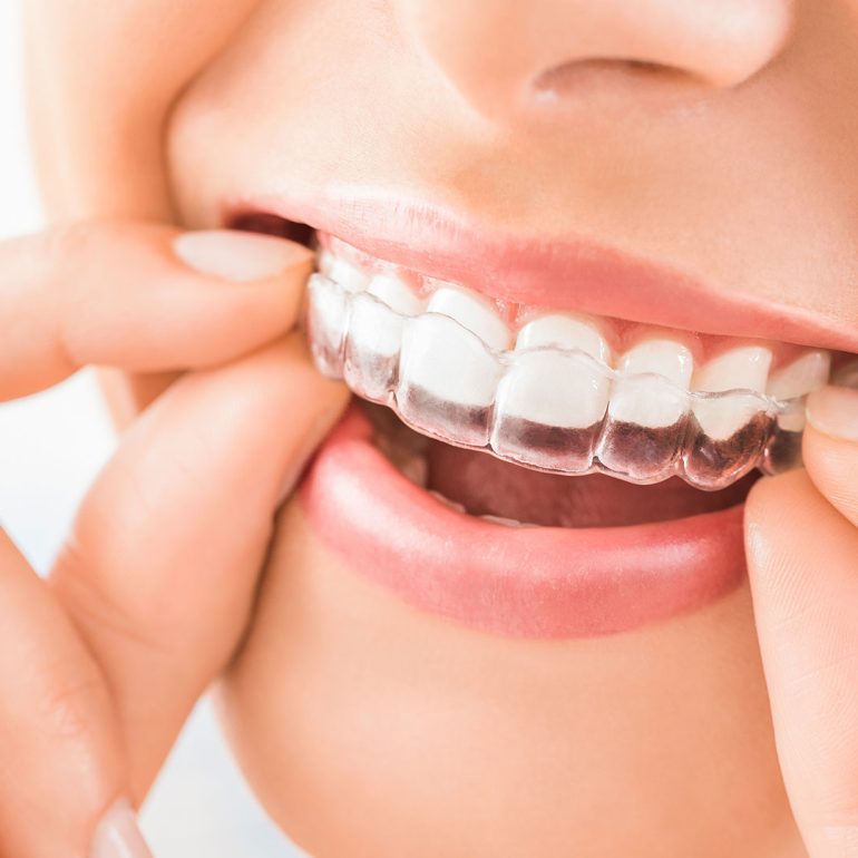 Clear aligners Invisalign in Bonita Springs FL