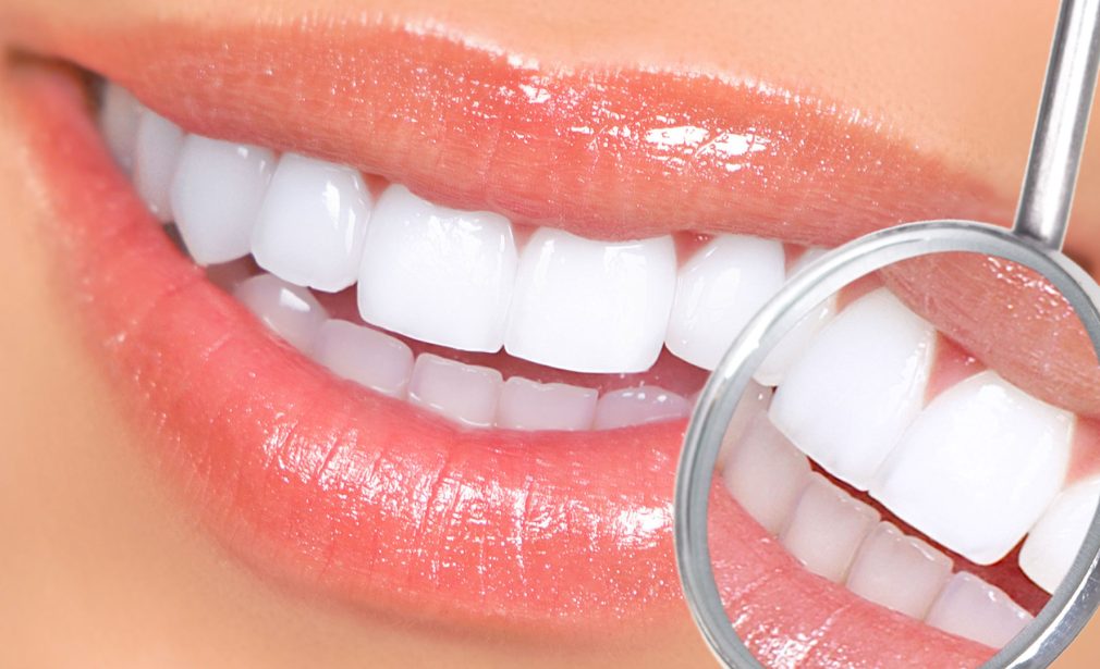 Take-Home-Teeth-Whitening-Bonita-Springs