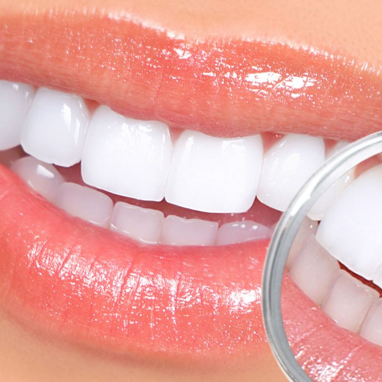 Take-Home-Teeth-Whitening-Bonita-Springs