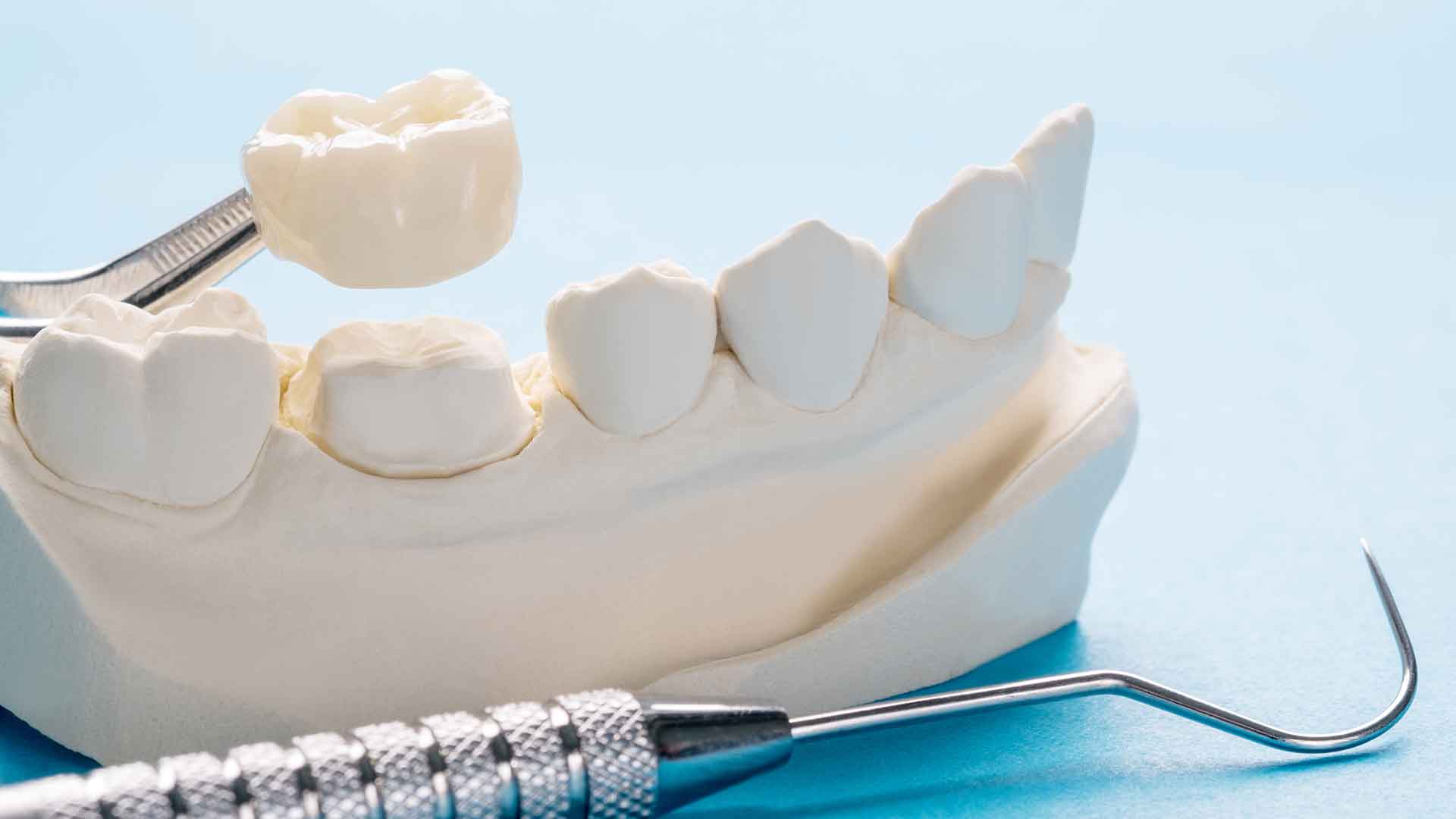 Dental Crowns in Bonita Springs Dental crown model placed over a prepared tooth for crown treatment