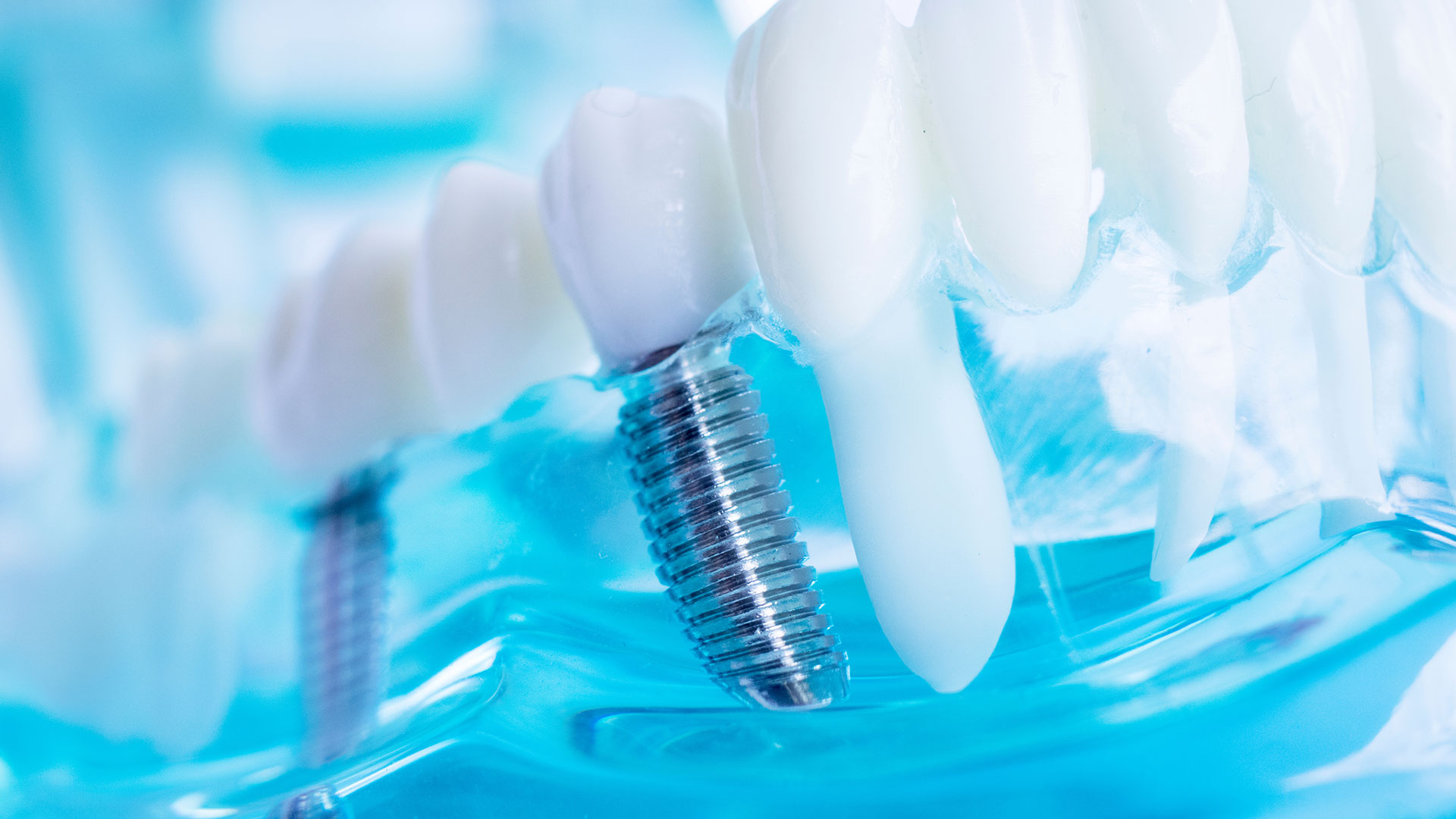 Dental Implants in Bonita Springs Illustration of a dental implant replacing a missing tooth in Bonita Springs