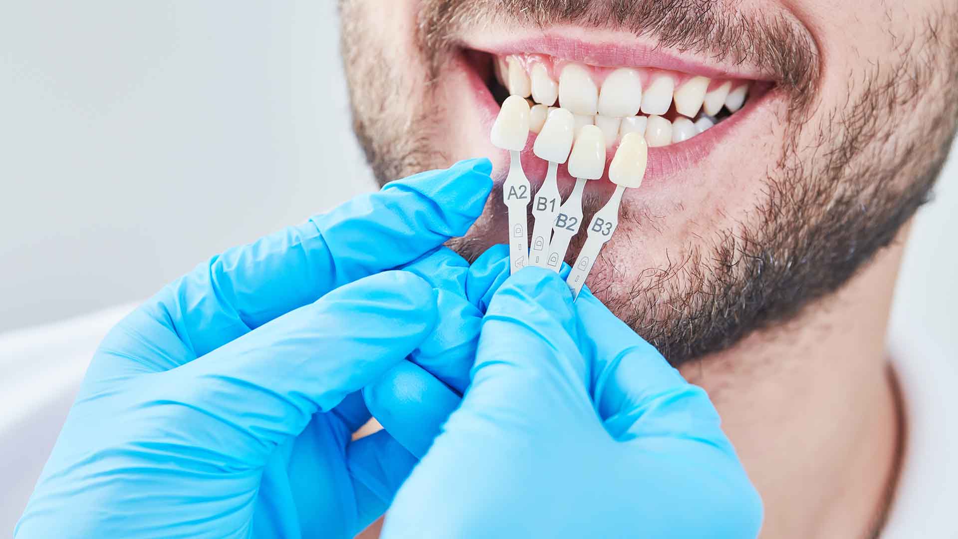 Dental Veneers Bonita Springs Dentist performing shade matching for dental veneers in Bonita Springs, FL