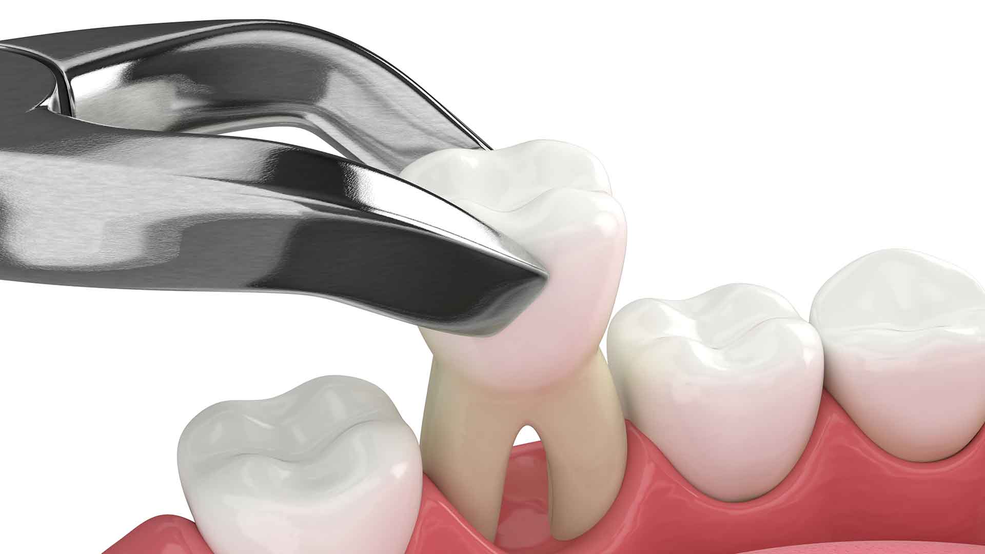 Tooth Extractions in Bonita Springs Clinical evaluation for tooth extractions in Bonita Springs, FL