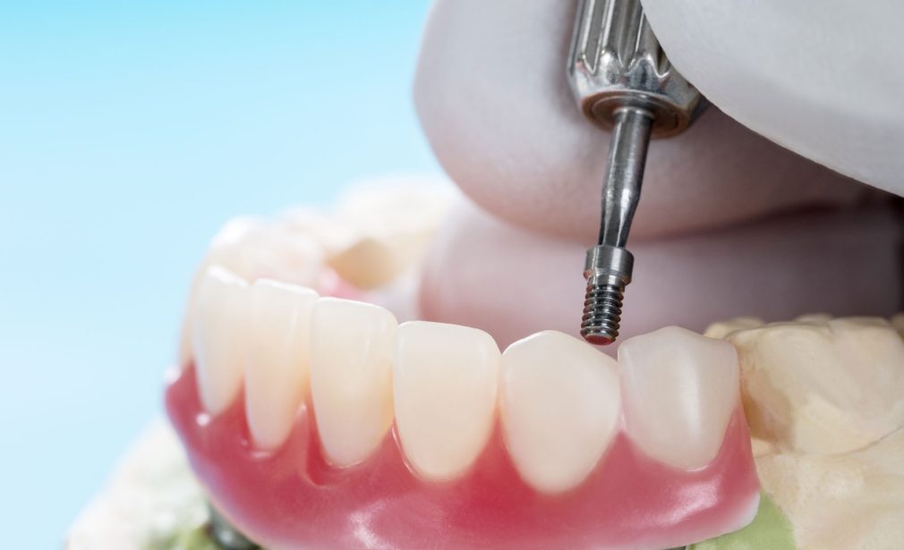 Overdentures in Cape Coral, Florida 33990