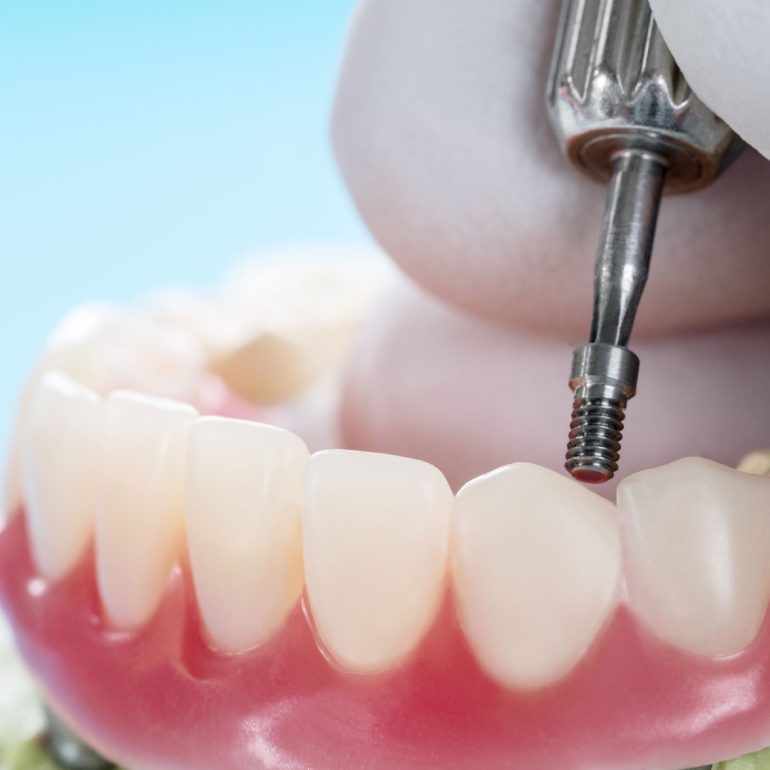 Overdentures in Cape Coral, Florida 33990
