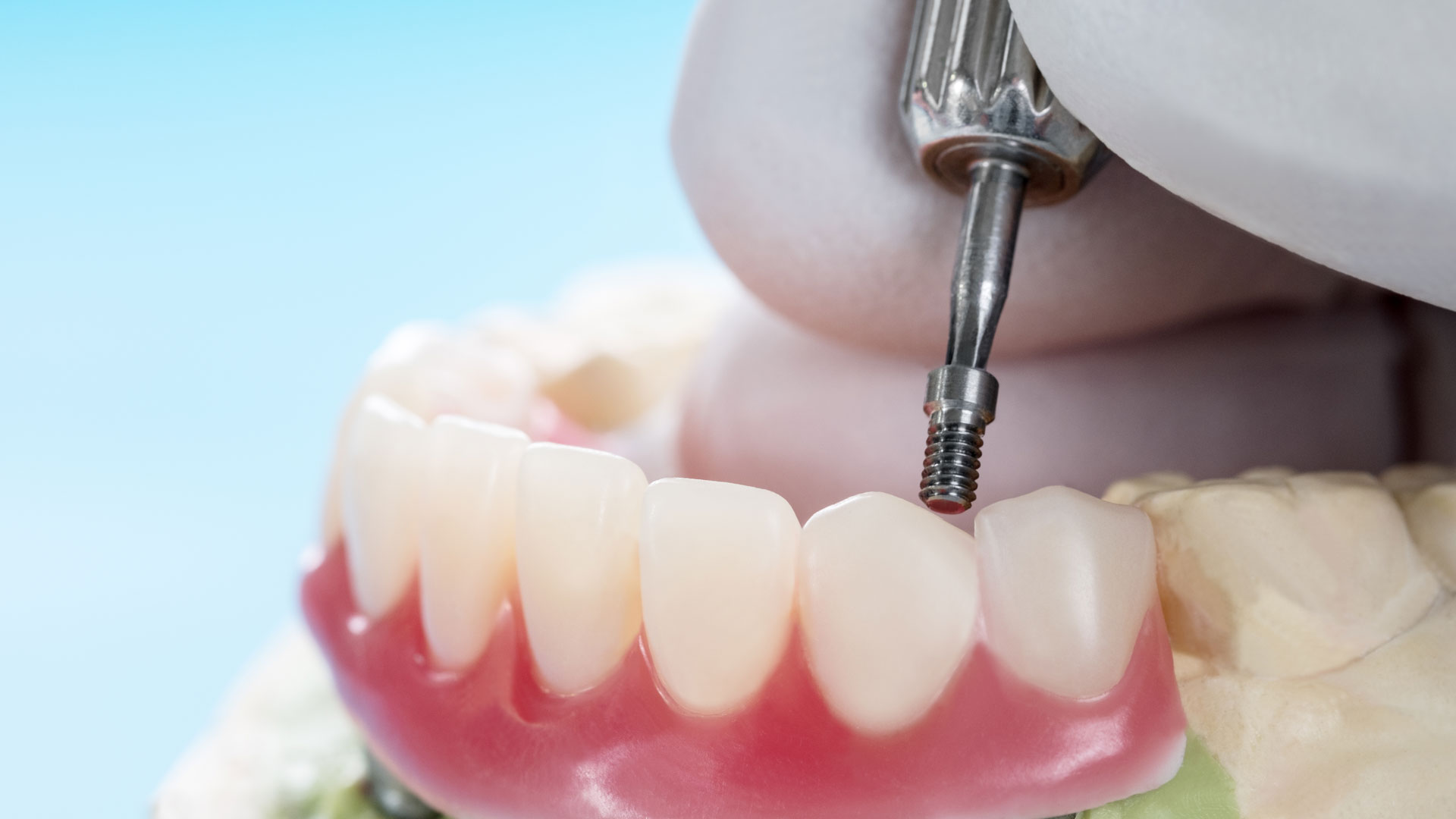 Overdentures in Cape Coral Implant-supported overdenture model for tooth replacement in Cape Coral