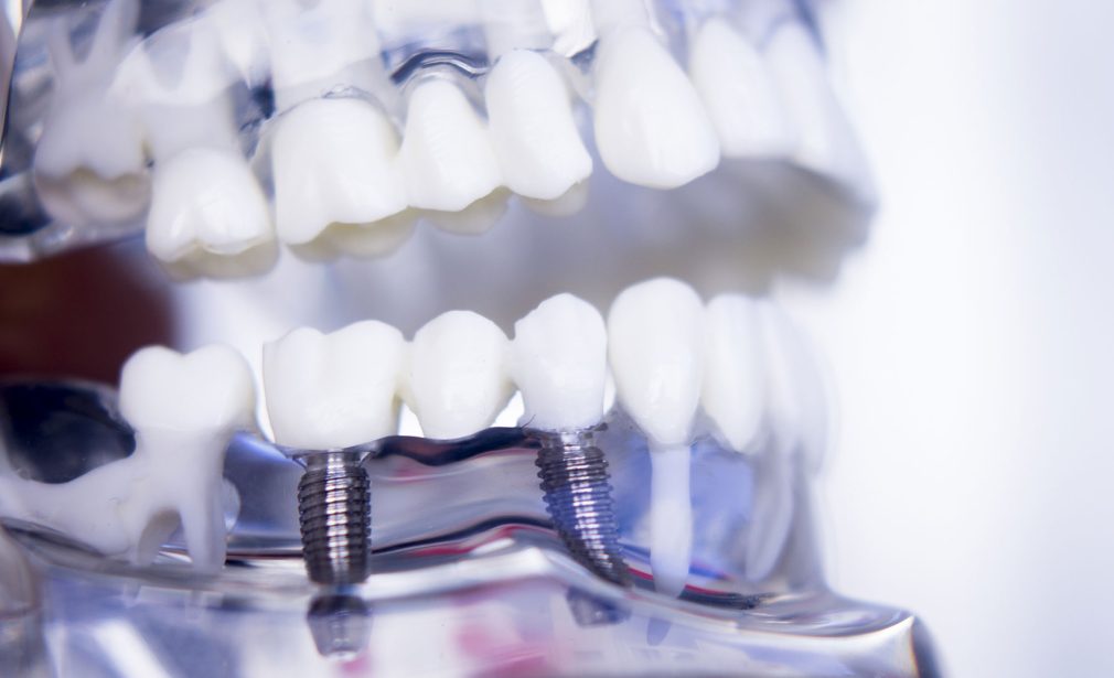 Implant placement procedure in Cape Coral – Dental Blush clinic