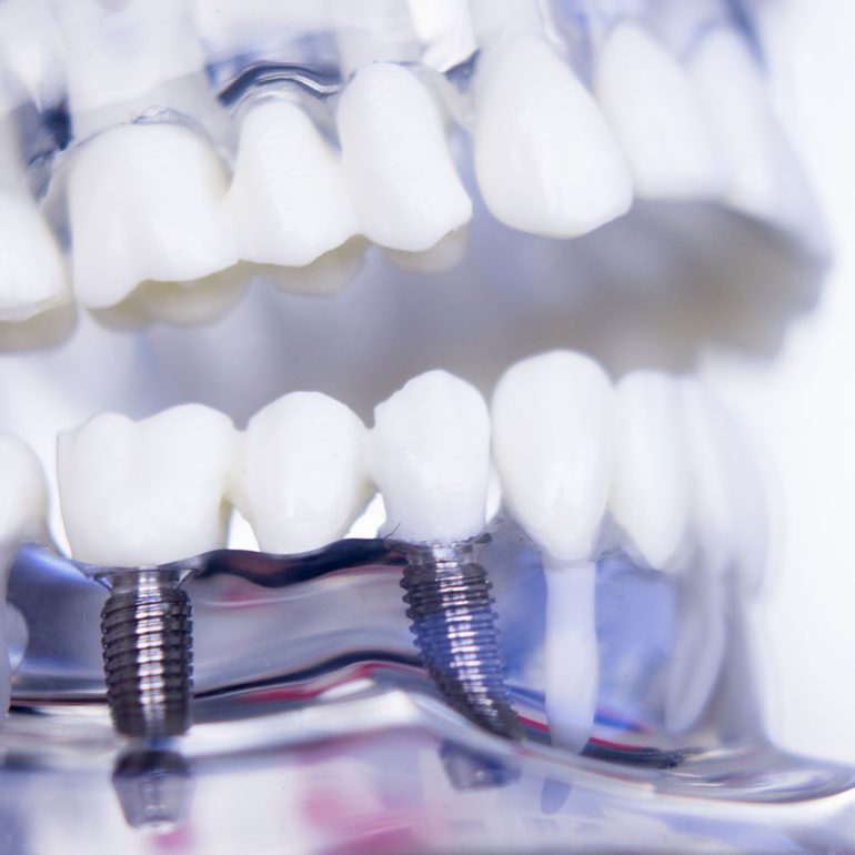 Implant placement procedure in Cape Coral – Dental Blush clinic