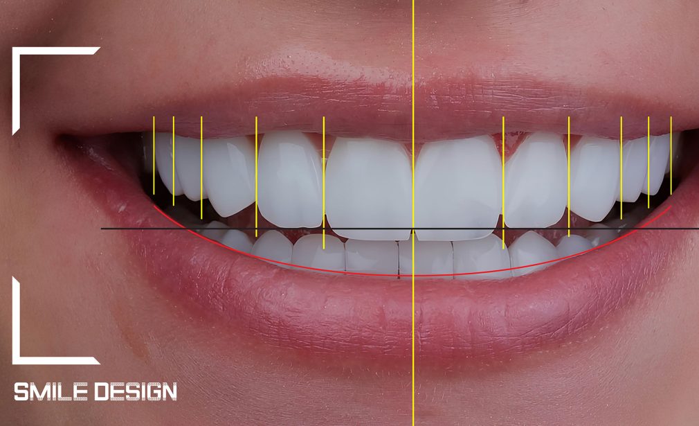 Dental Smile Design in Cape Coral consultation at Dental Blush – Cape Coral, FL