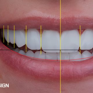 Dental Smile Design in Cape Coral consultation at Dental Blush – Cape Coral, FL