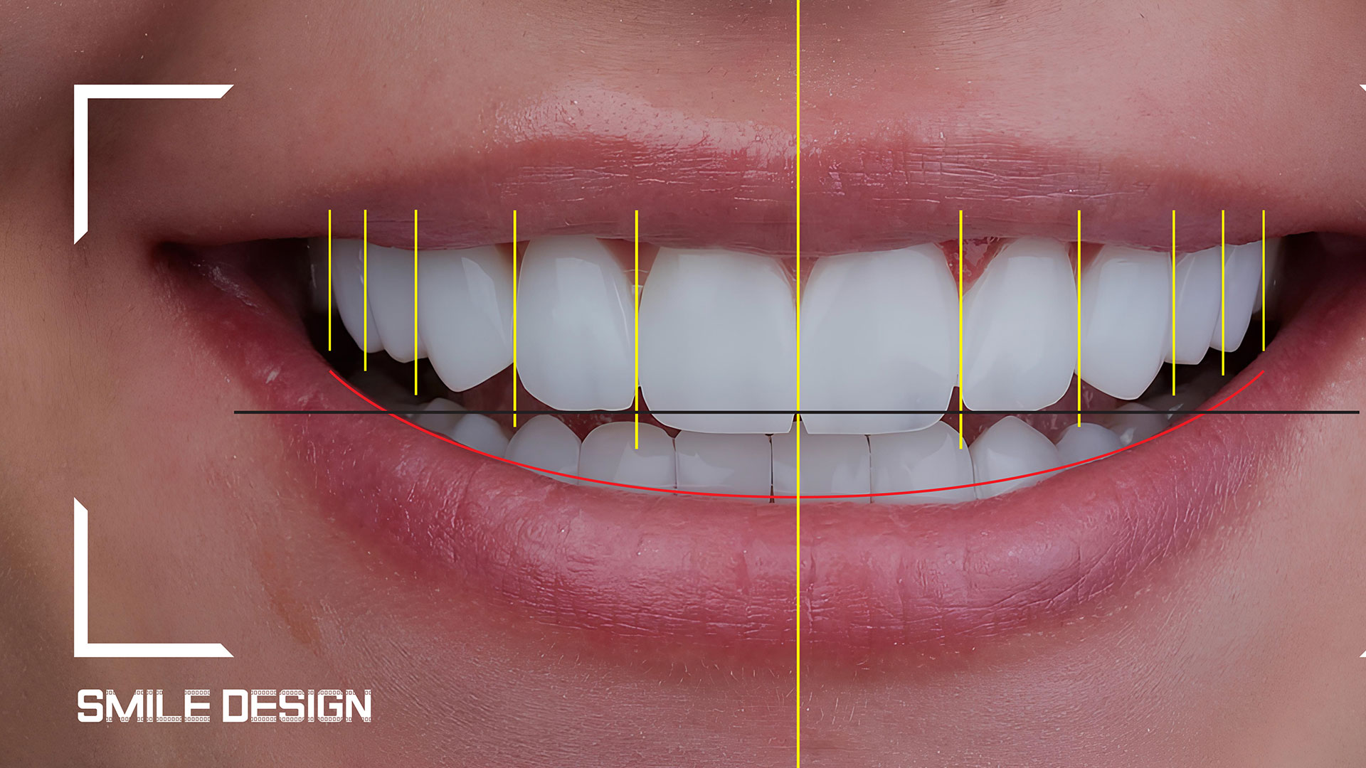 Dental Smile Design in Cape Coral Digital smile design planning for cosmetic dentistry in Cape Coral
