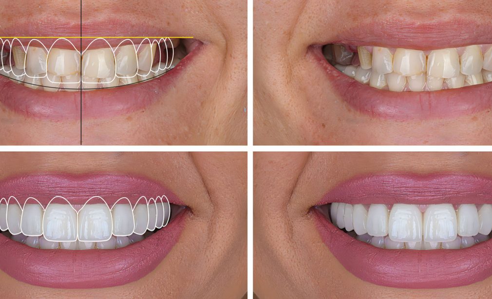 Before and After Smile Design in Cape Coral, FL