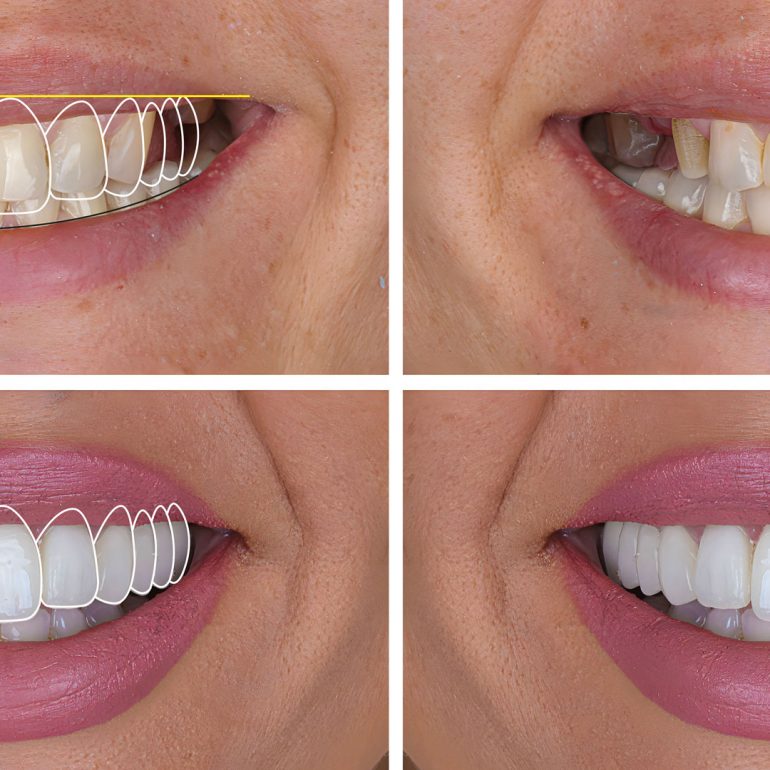 Before and After Smile Design in Cape Coral, FL