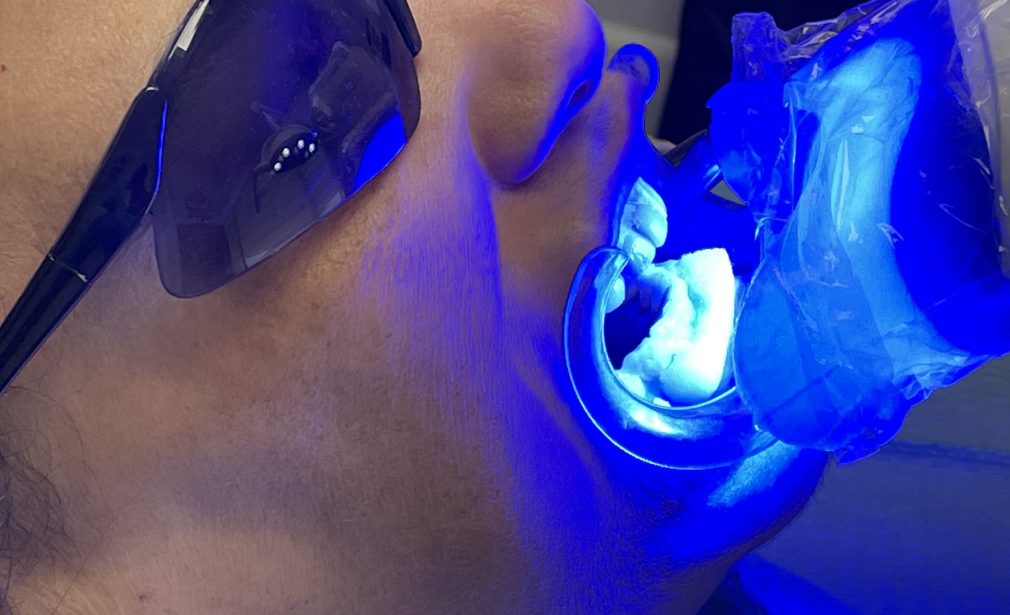 Professional teeth whitening in Cape Coral FL