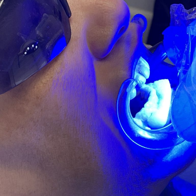 Professional teeth whitening in Cape Coral FL