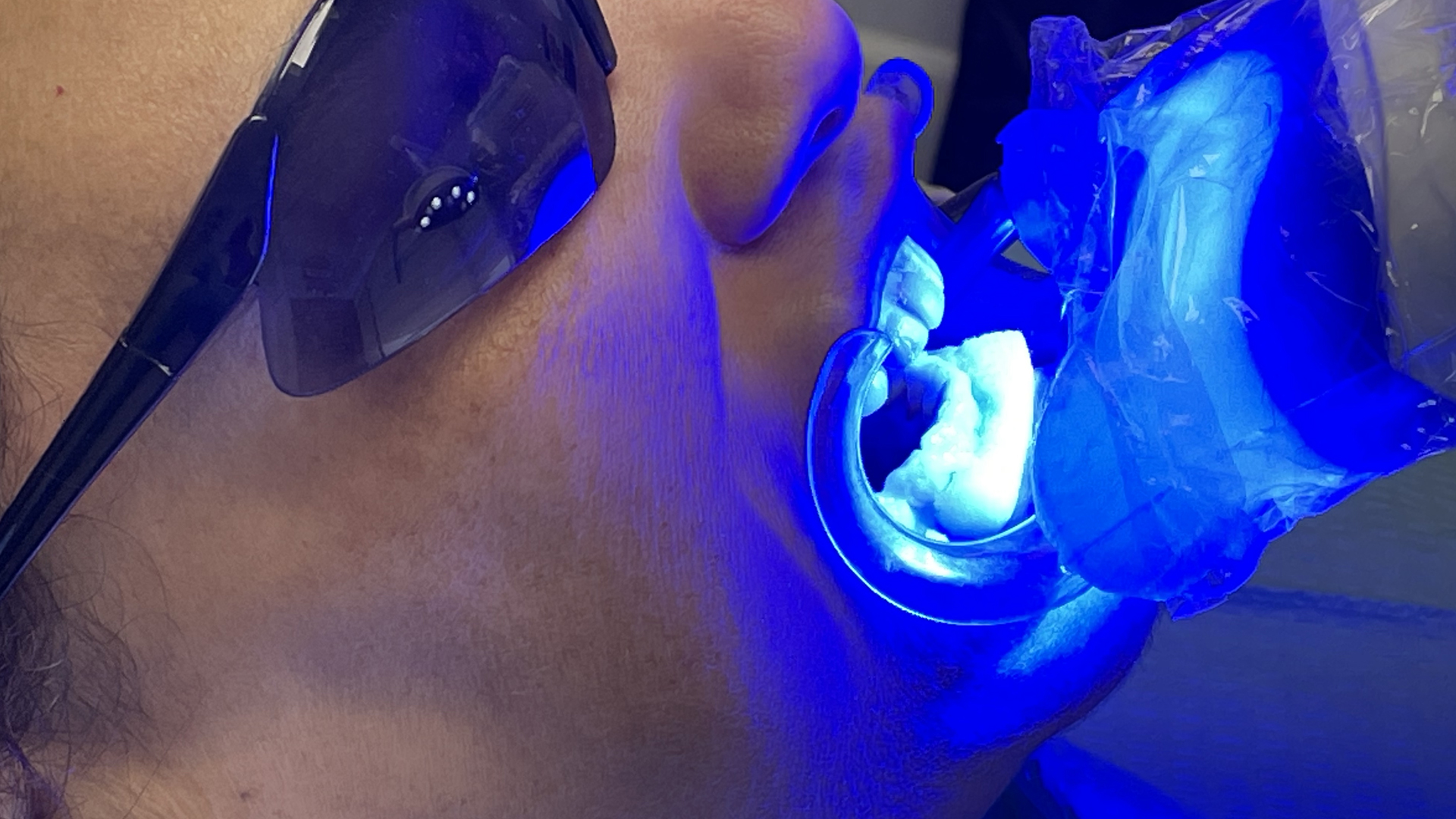 Teeth Whitening in Cape Coral at Dental Blush Cape Coral