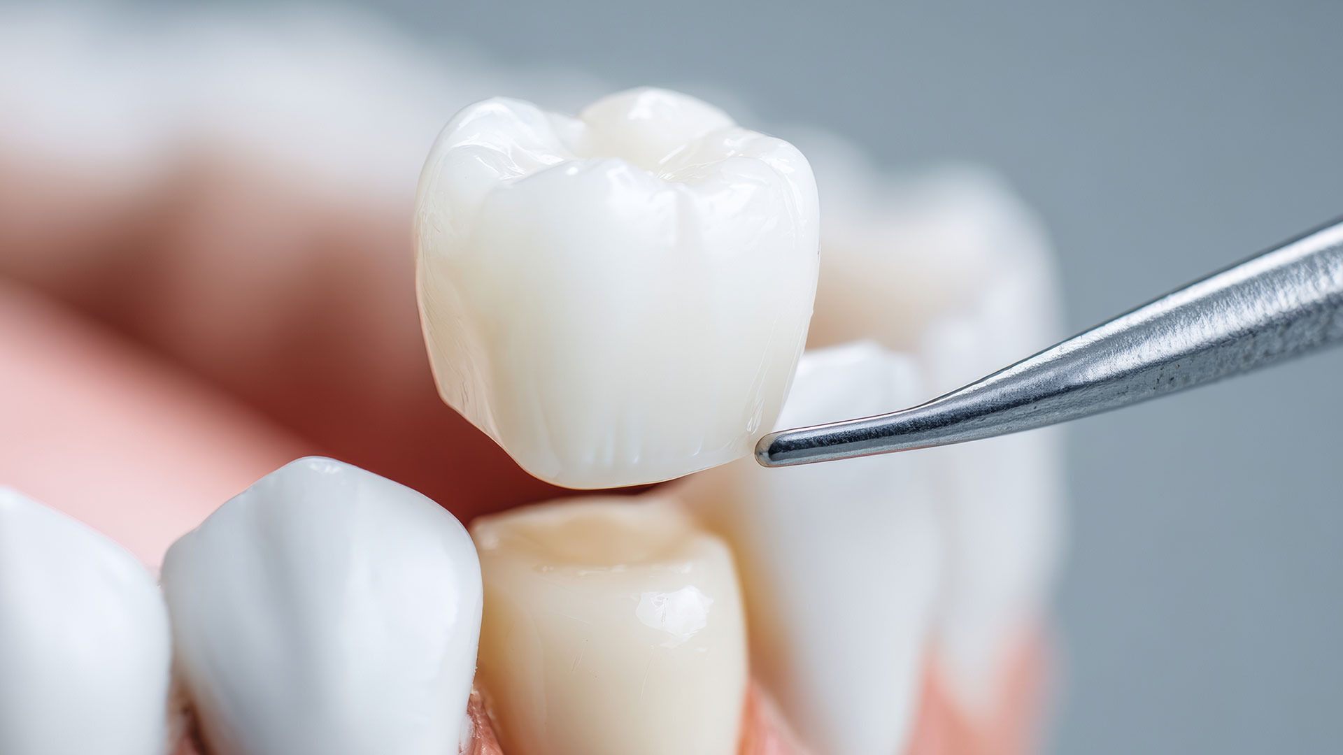 Dental Crowns in Cape Coral Dental crown evaluation for a damaged tooth in Cape Coral
