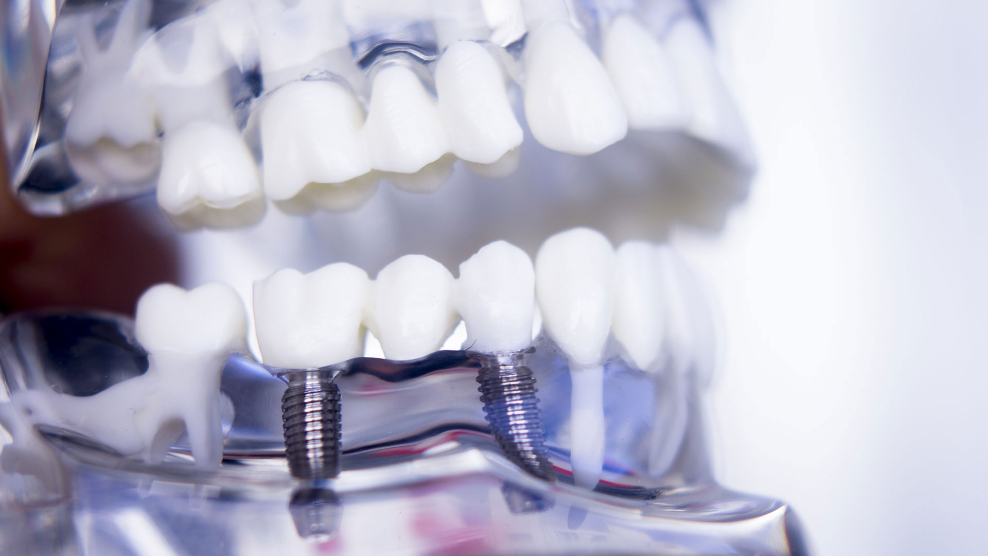 Dental Implants in Cape Coral Dental Blush Cape Coral team reviewing 3D imaging for dental implant treatment