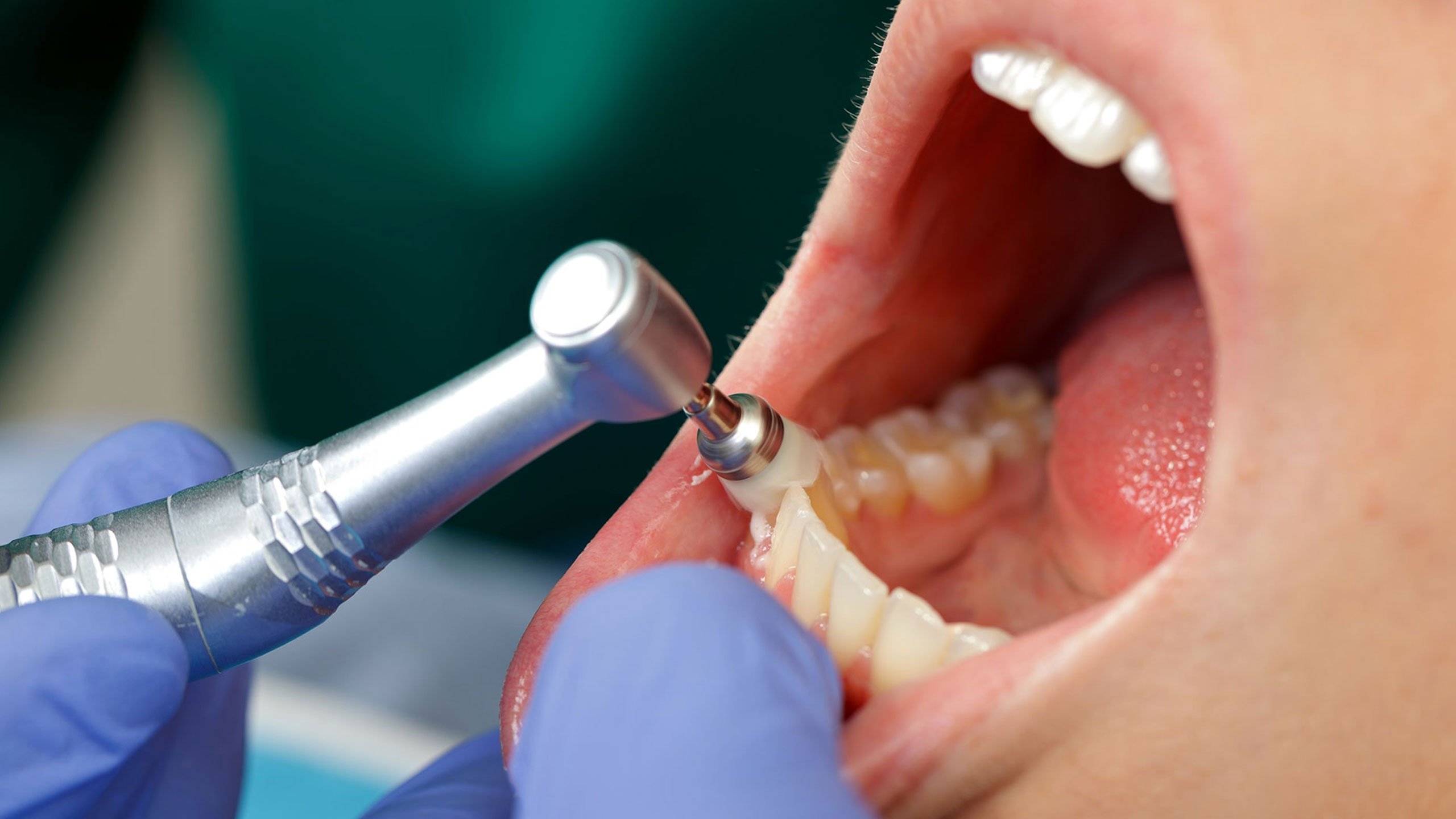 Teeth Cleaning in Cape Coral Professional teeth cleaning in Cape Coral to remove plaque, tartar, and surface stains