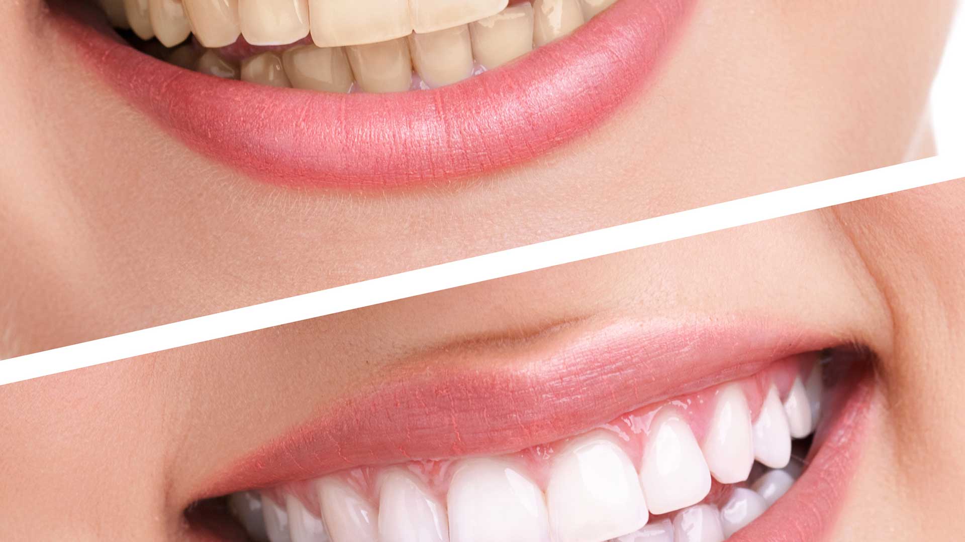 Teeth Whitening in Cape Coral Professional teeth whitening consultation and smile evaluation in Cape Coral