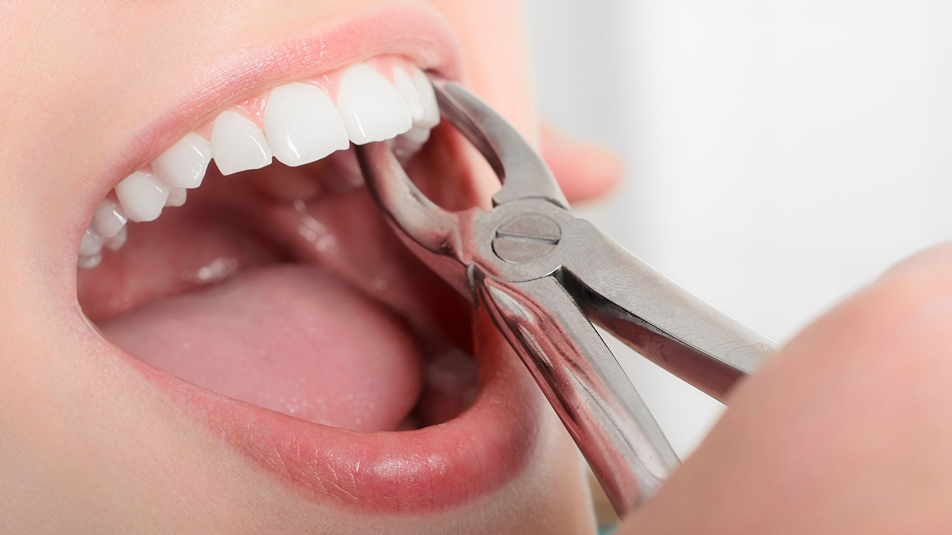 Tooth Extraction in Cape Coral Dental evaluation for a possible tooth extraction in Cape Coral