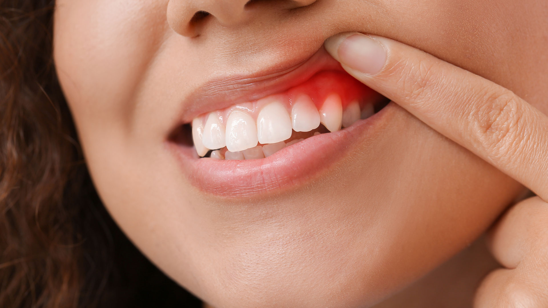 Dental Periodontics Cape Coral Red and inflamed gums showing signs of periodontal disease