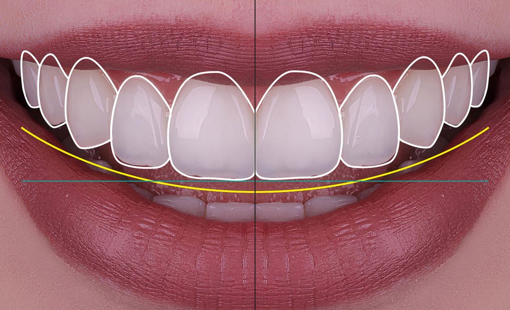 Before and After Smile Design Transformation