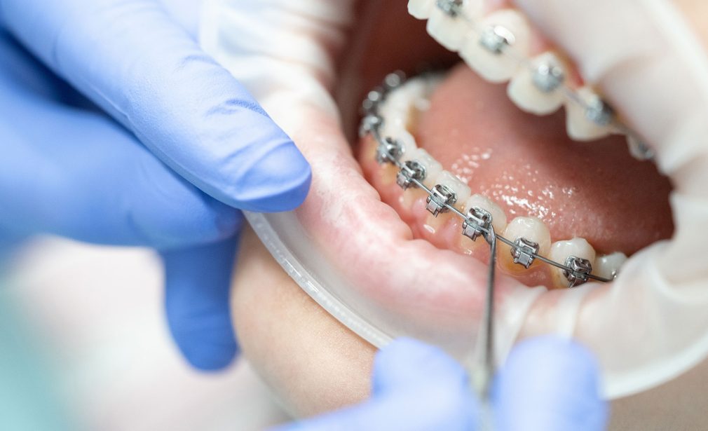 Invisalign Orthodontic Treatment in Lauderhill/Sunrise