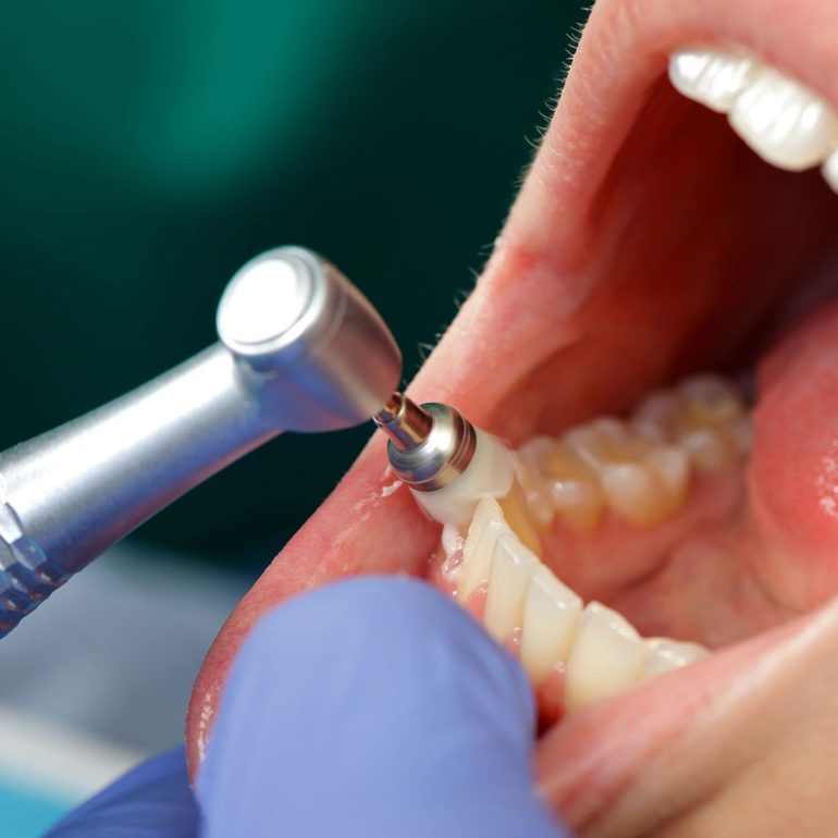 Patient Getting Professional Dental Cleaning in Lauderhill