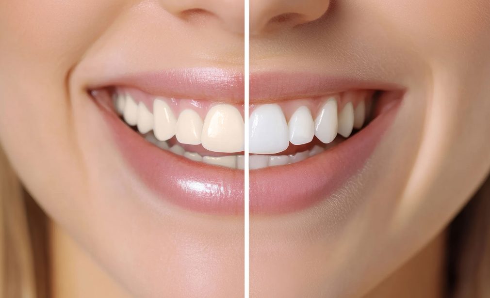 Bright Smile After Professional Whitening in Lauderhill
