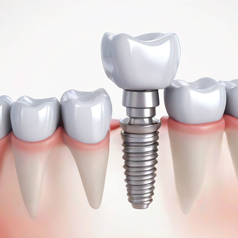 Dental Blush Implant Dentist Sunrise/*Lauderhill FL