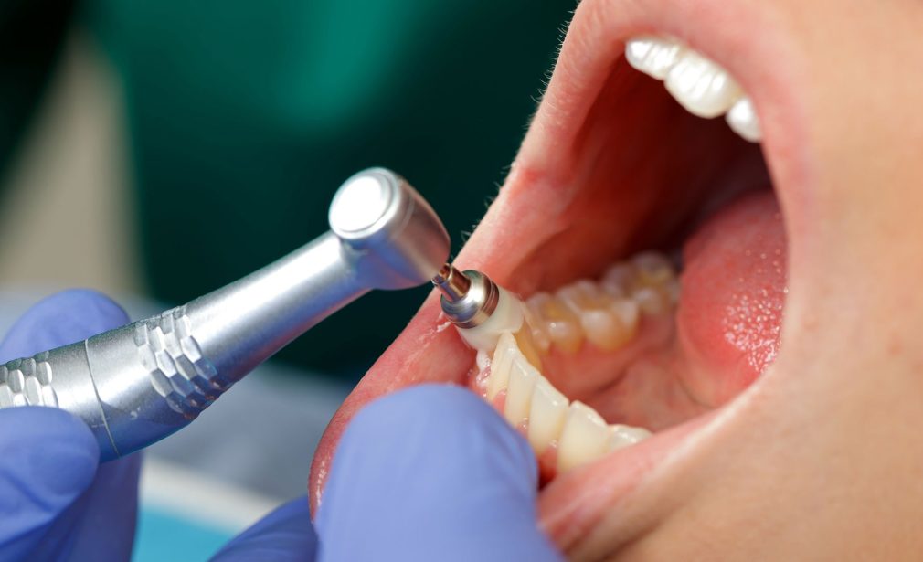 Patient Getting Professional Dental Cleaning in Lauderhill