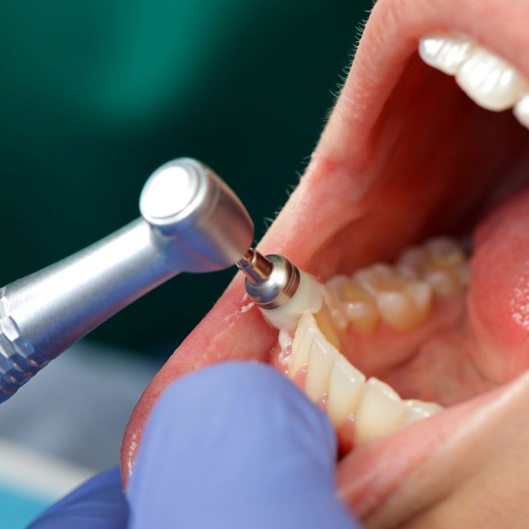 Patient Getting Professional Dental Cleaning in Lauderhill