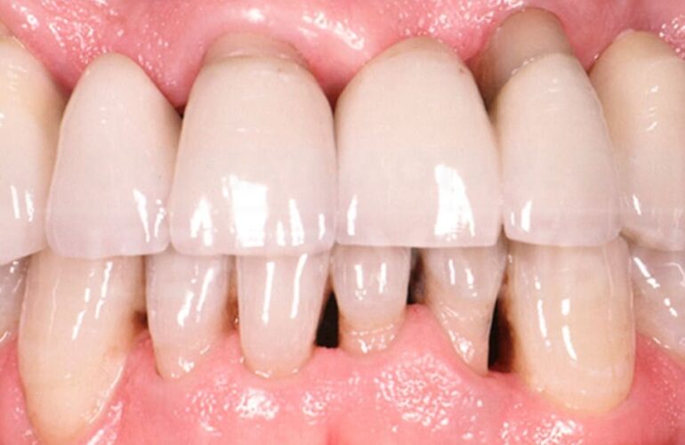 Dental Blush periodontitis-770x500 Services  