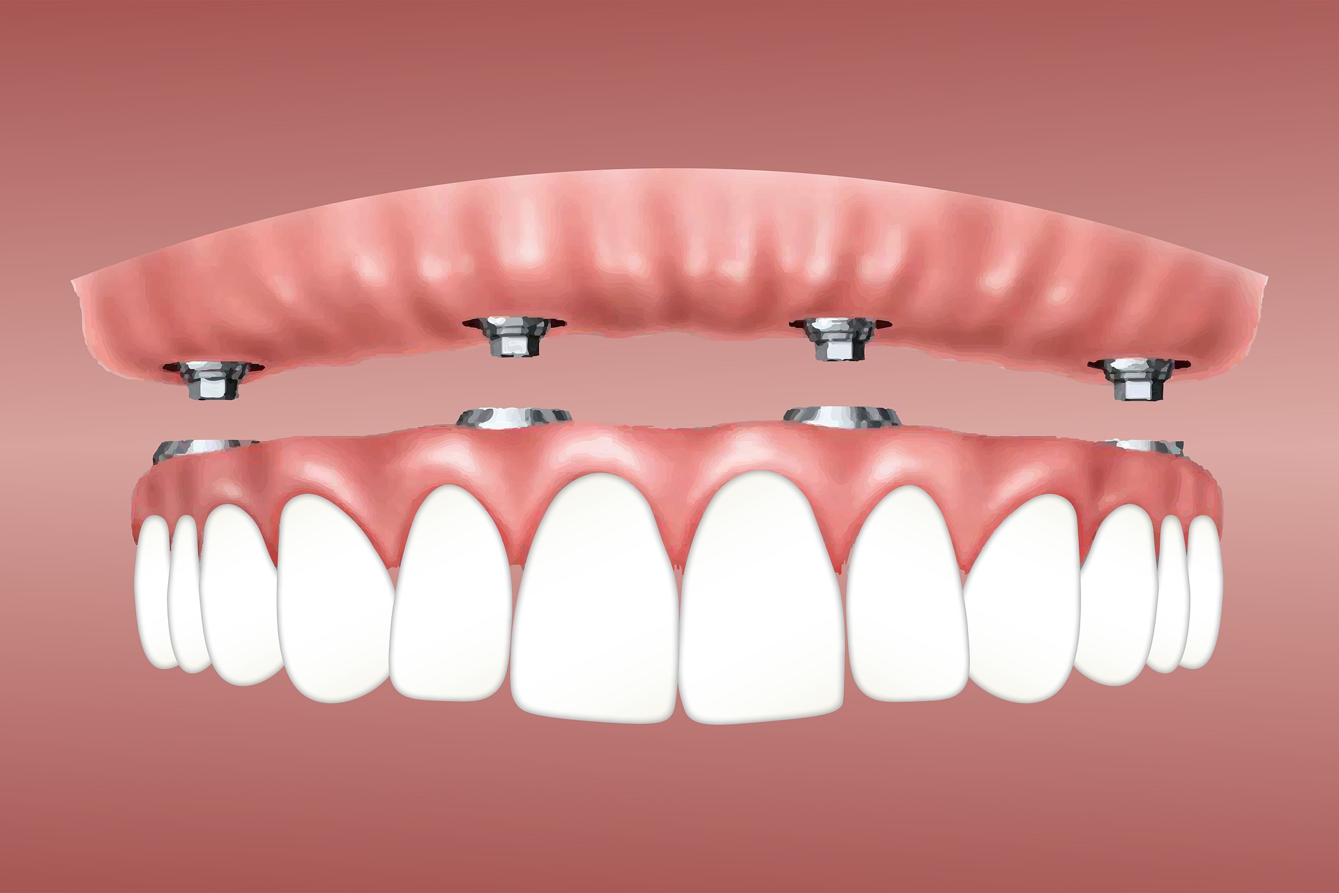 Dental Blush implants Benefits of Dental Implants with Miami Top Dentists Implants  dental implants near me Dental Implants Miami FL dental implants dental implant cost dental clinic Benefits of Dental Implants 