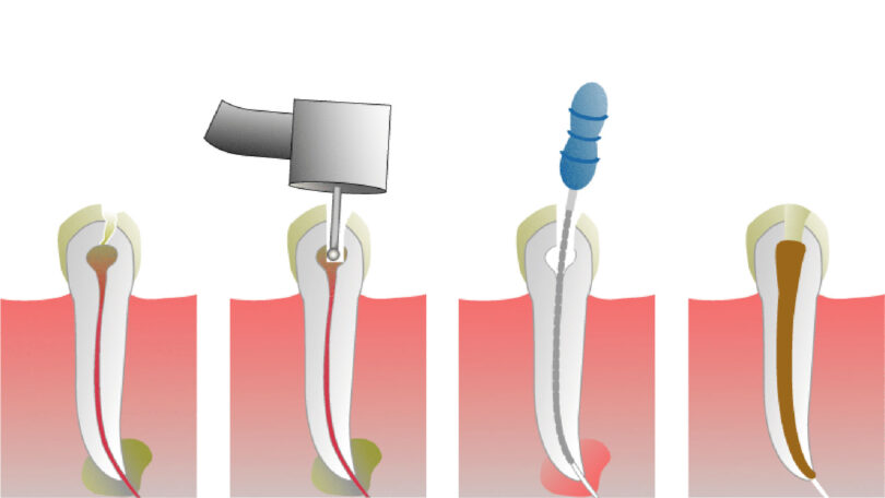 Dental Blush root_canal-e1596410469765 Get your smile back with Root Canal Treatment Dental  root canals Root Canal Treatment in Miami Root Canal Treatment 