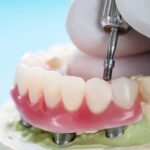 Dental Blush overdenture-150x150 Guide to Overdentures in Miami: Types, Benefits, and Best Alternatives Implants  Overdentures in Miami Overdentures Implant overdentures Benefits Of Overdenture 
