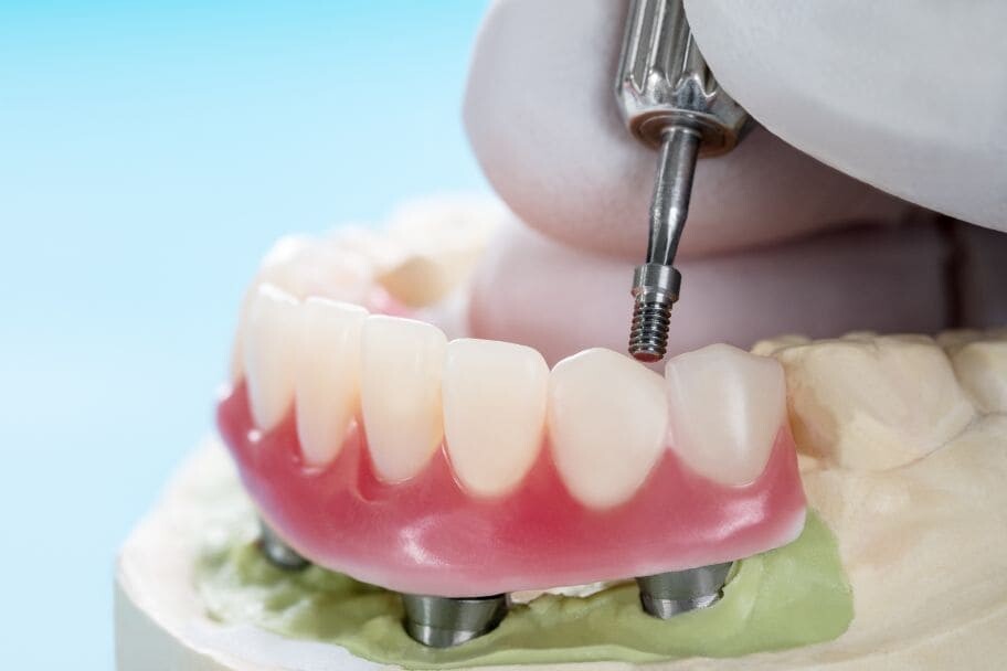 Dental Blush overdenture Guide to Overdentures in Miami: Types, Benefits, and Best Alternatives Implants  Overdentures in Miami Overdentures Implant overdentures Benefits Of Overdenture 