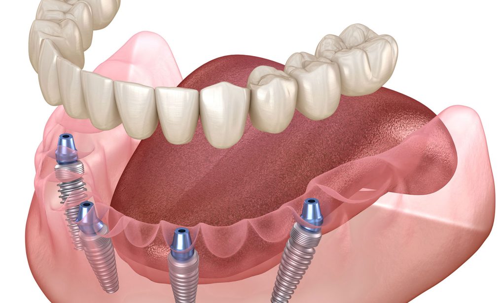 Overdentures in Miami at Dental Blush providing stable, natural-looking smile restoration