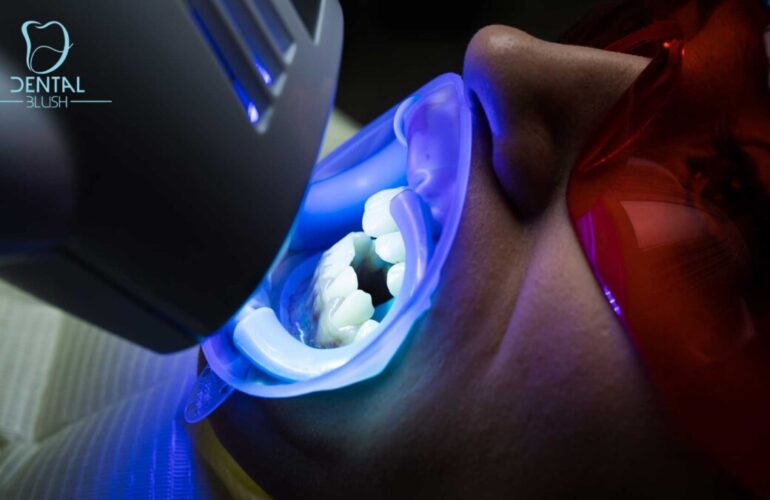 Dental Blush Teeth-Whitening-Miami-770x500 Our Services  
