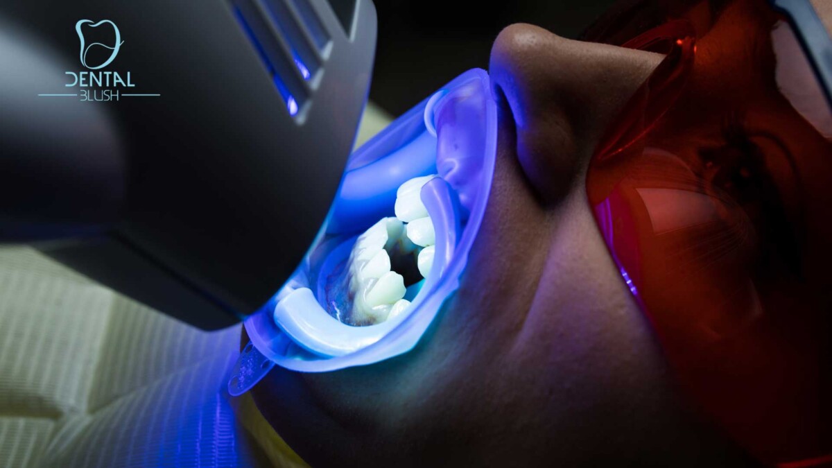 Dental Blush Teeth-Whitening-Miami Teeth Whitening  