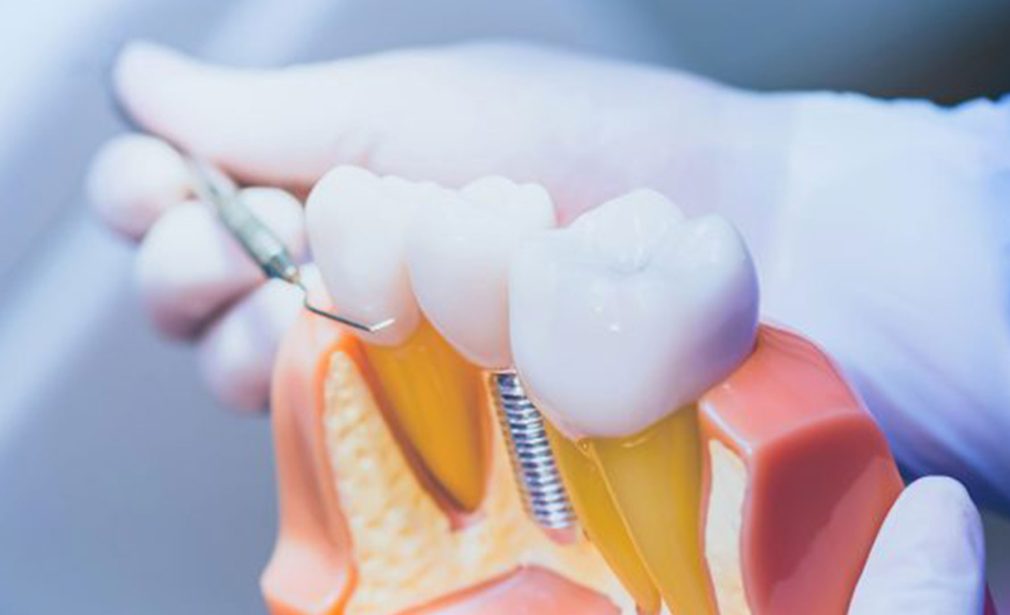 Dental implants in Miami FL Dental Blush