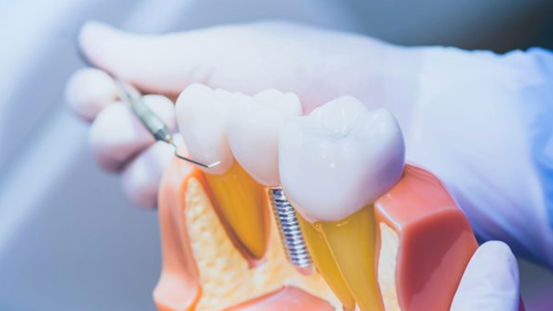 Expert Dental Implants in Miami at Dental Blush Tamiami near Fontainebleau and FIU area